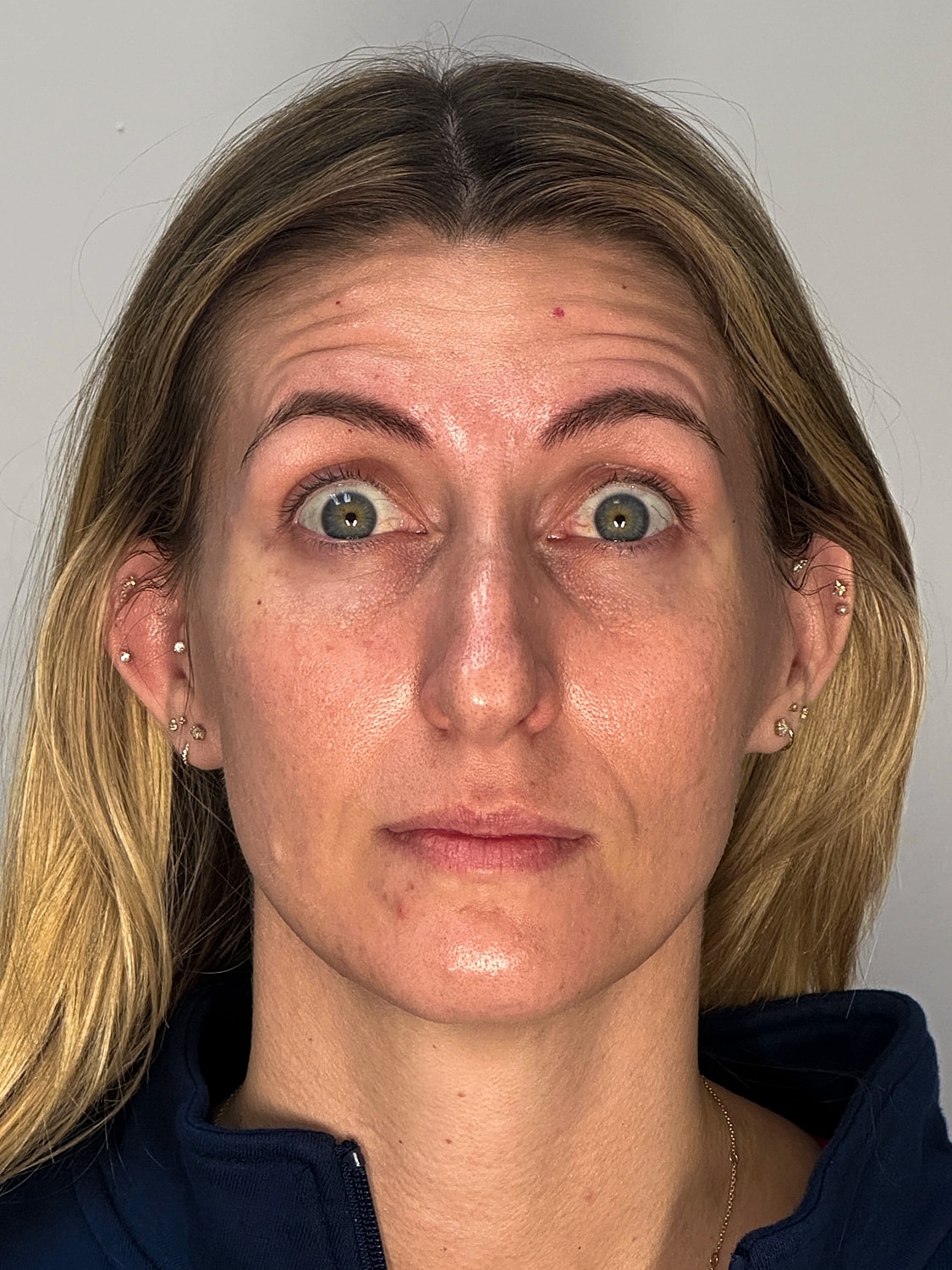 Facial Balancing Before & After