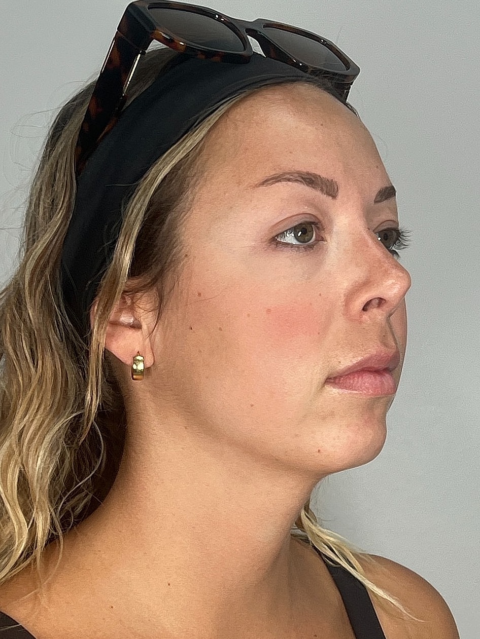 Facial Balancing Before & After