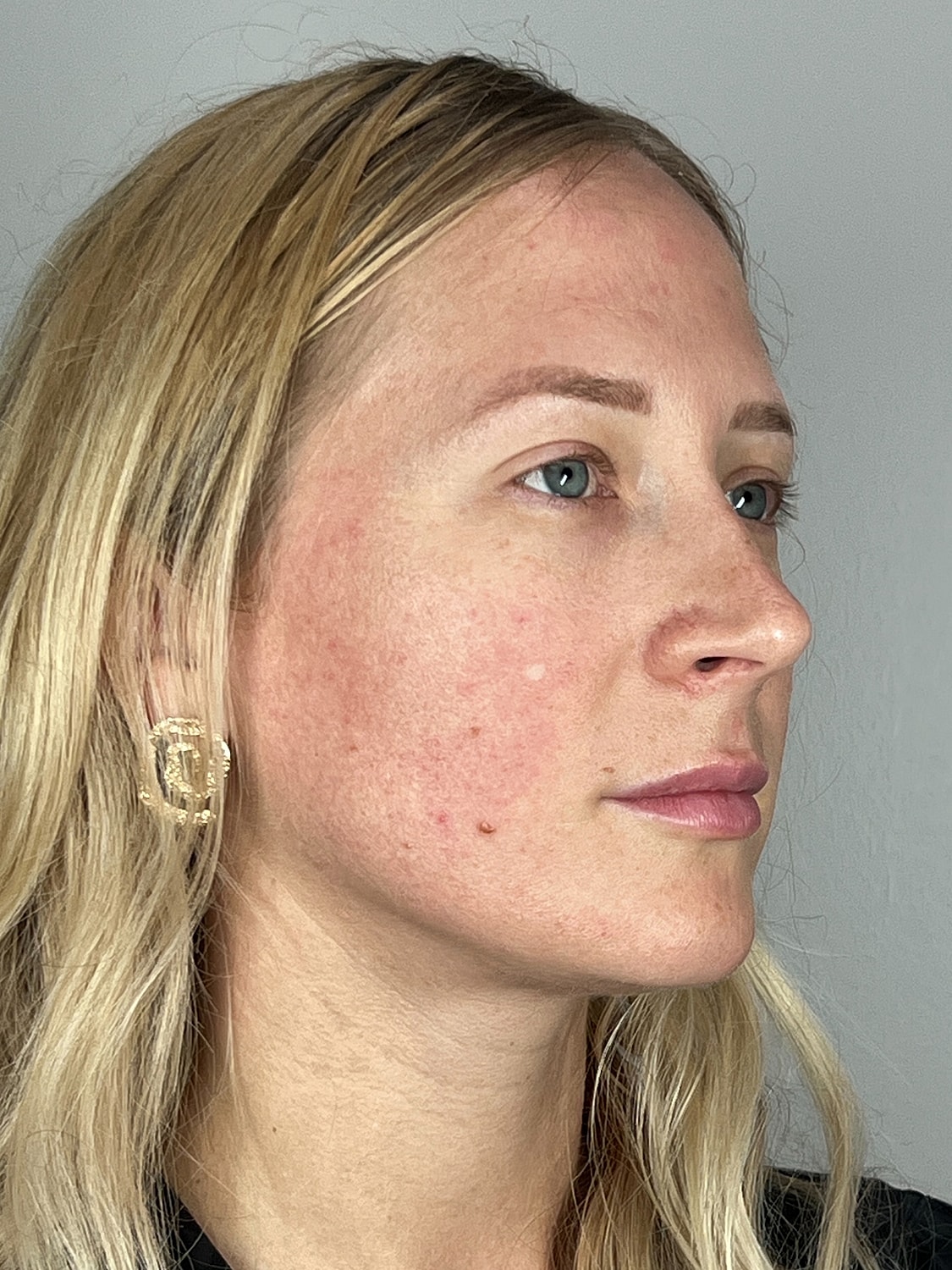 Facial Balancing Before & After