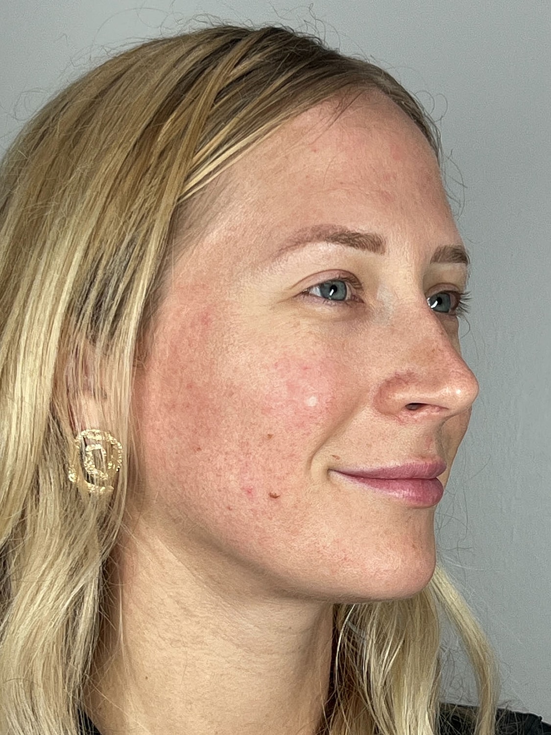Facial Balancing Before & After