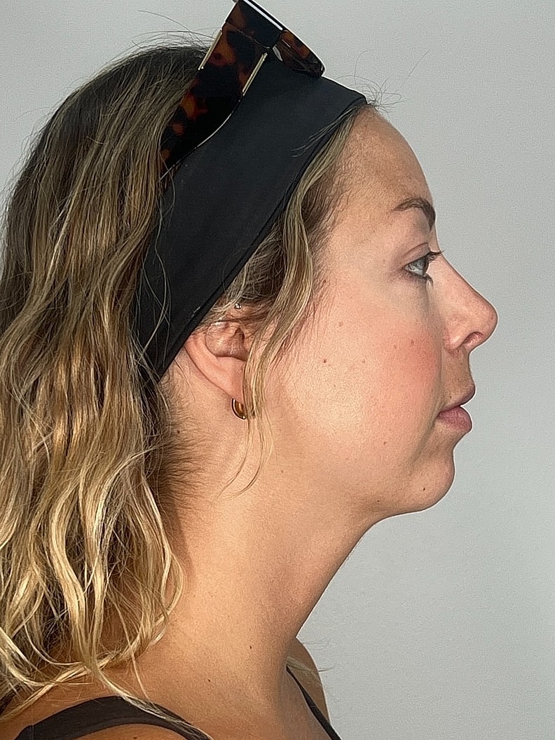 Facial Balancing Before & After