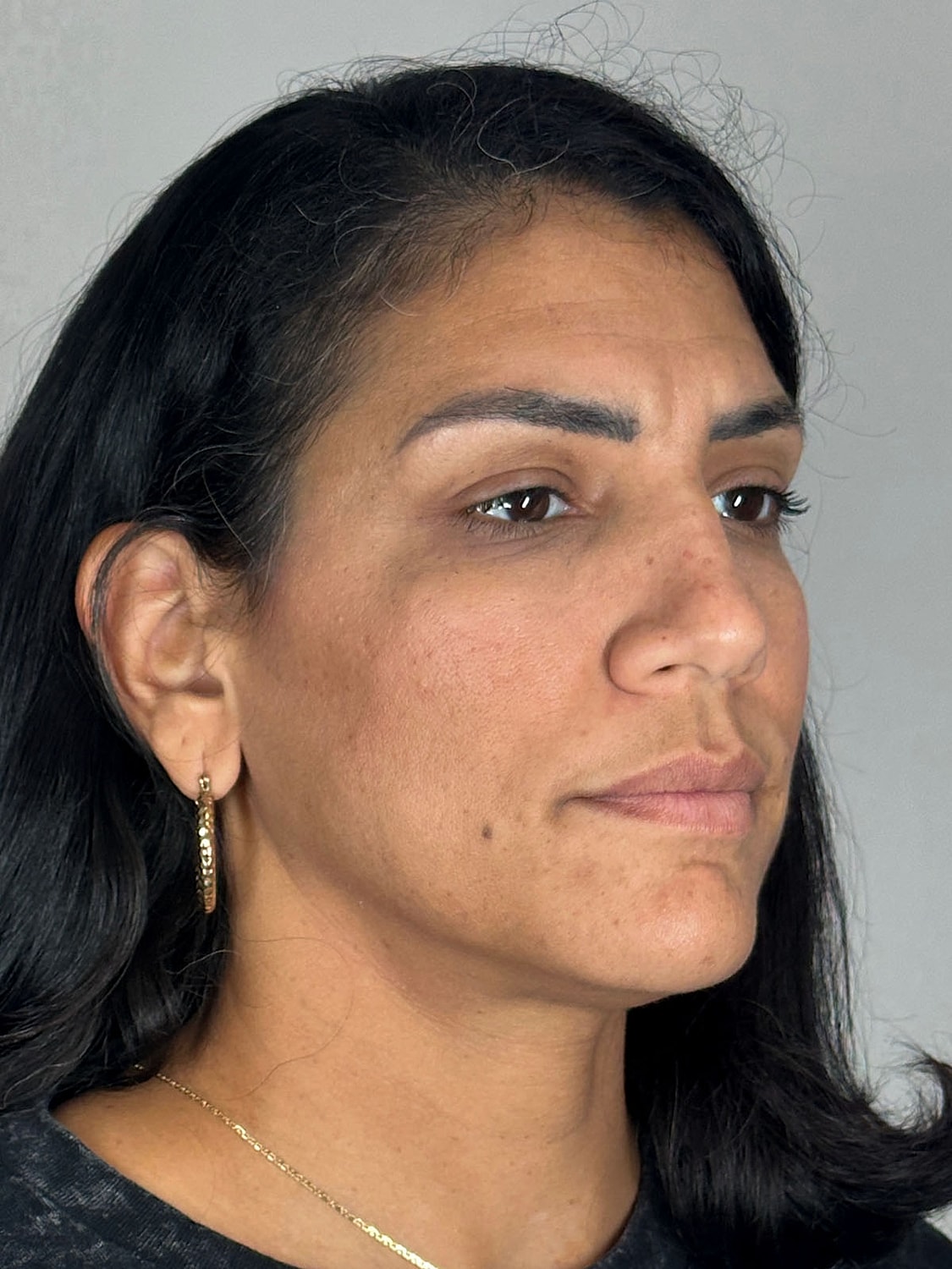 Facial Balancing Before & After