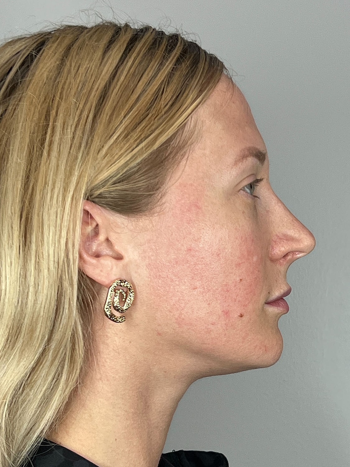 Facial Balancing Before & After
