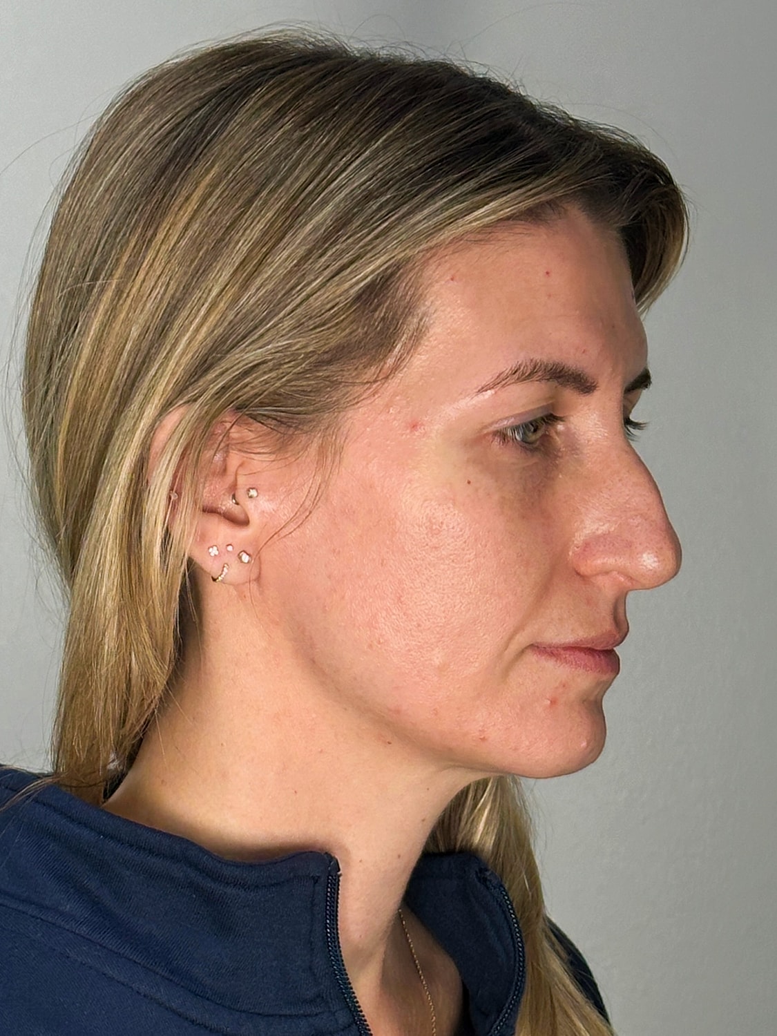 Facial Balancing Before & After