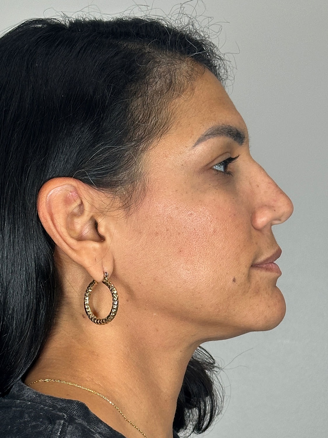 Facial Balancing Before & After