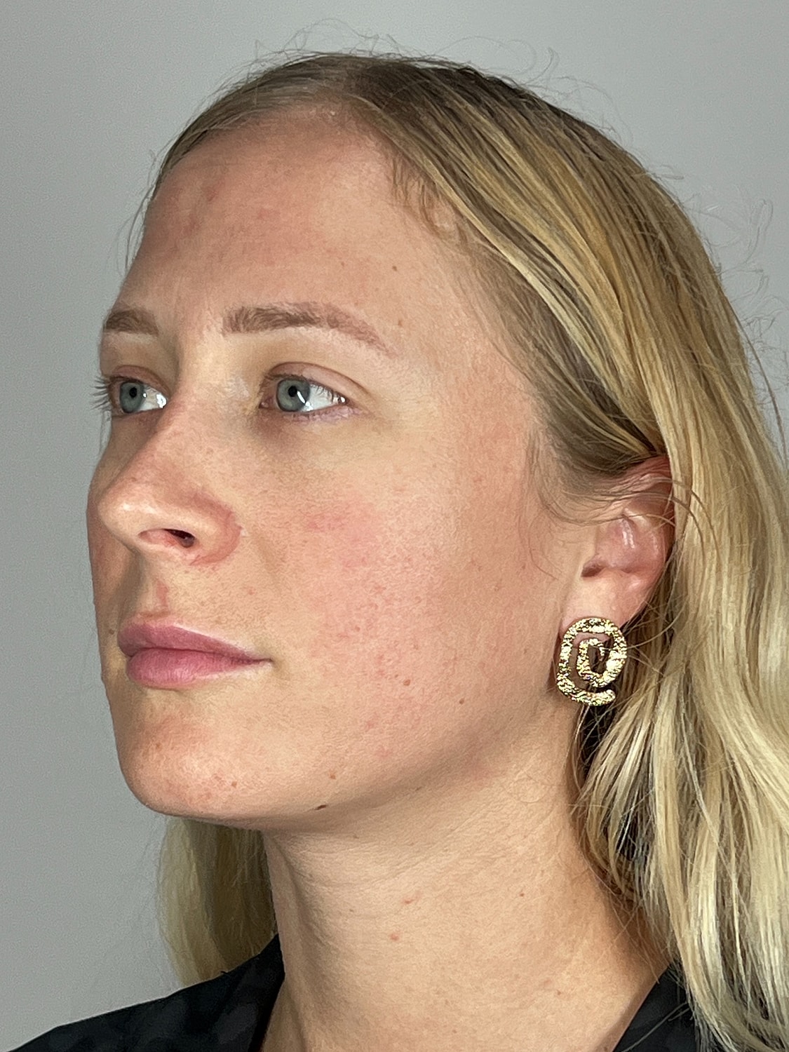 Facial Balancing Before & After