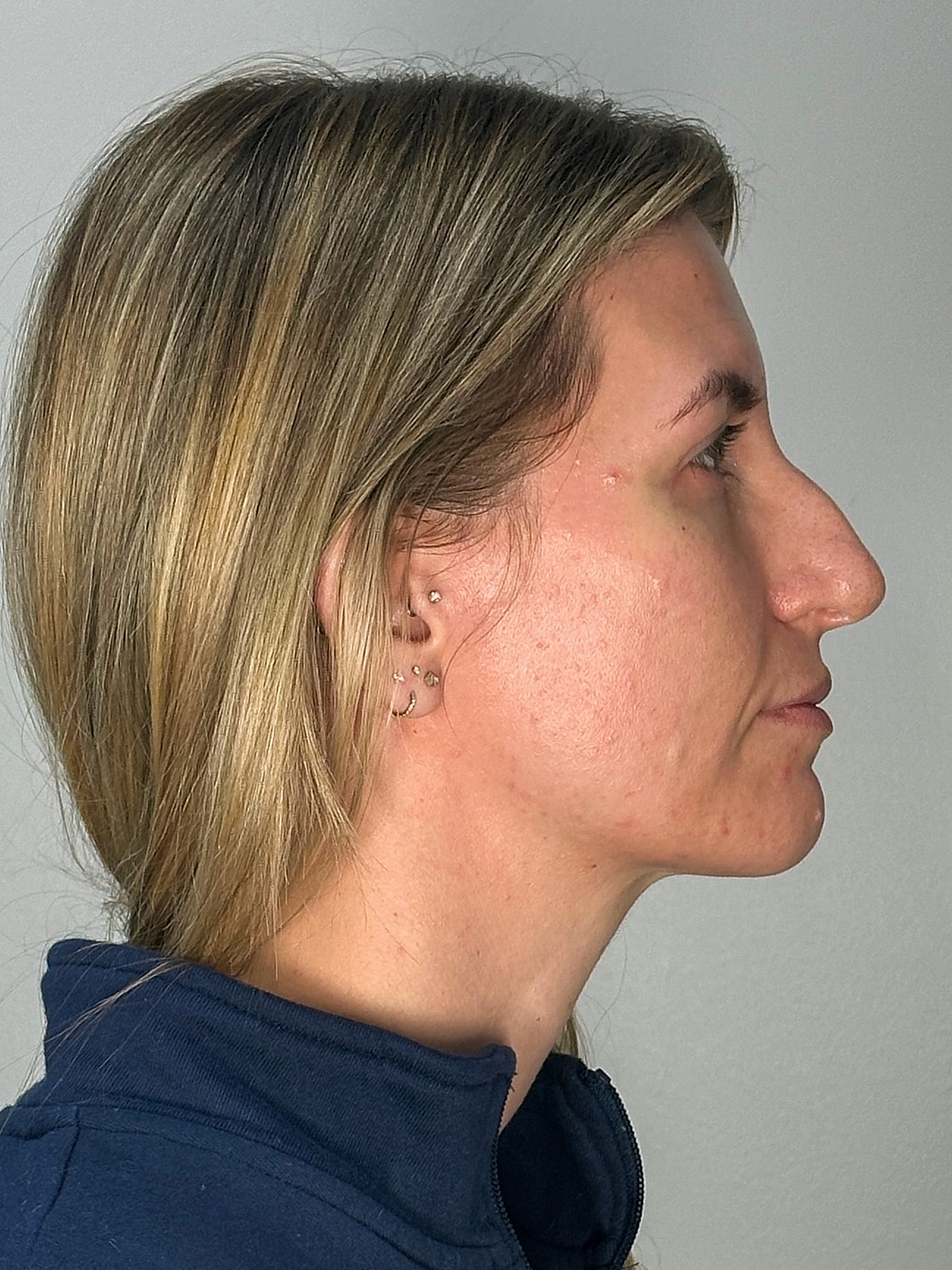 Facial Balancing Before & After