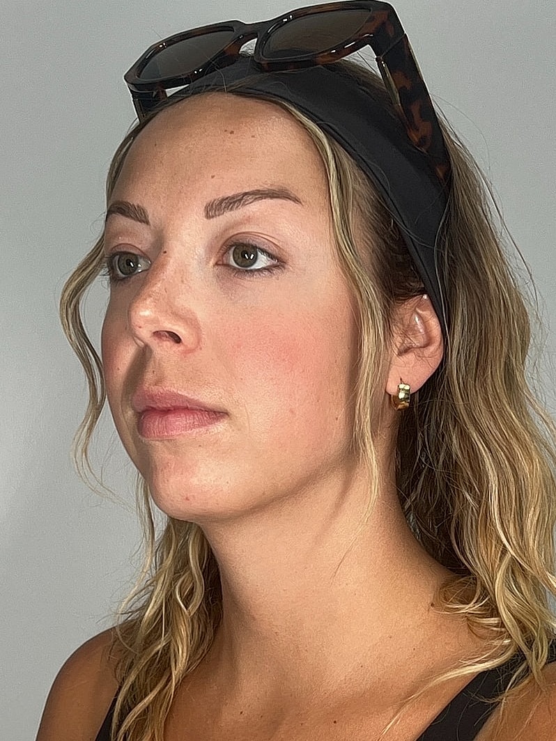 Facial Balancing Before & After