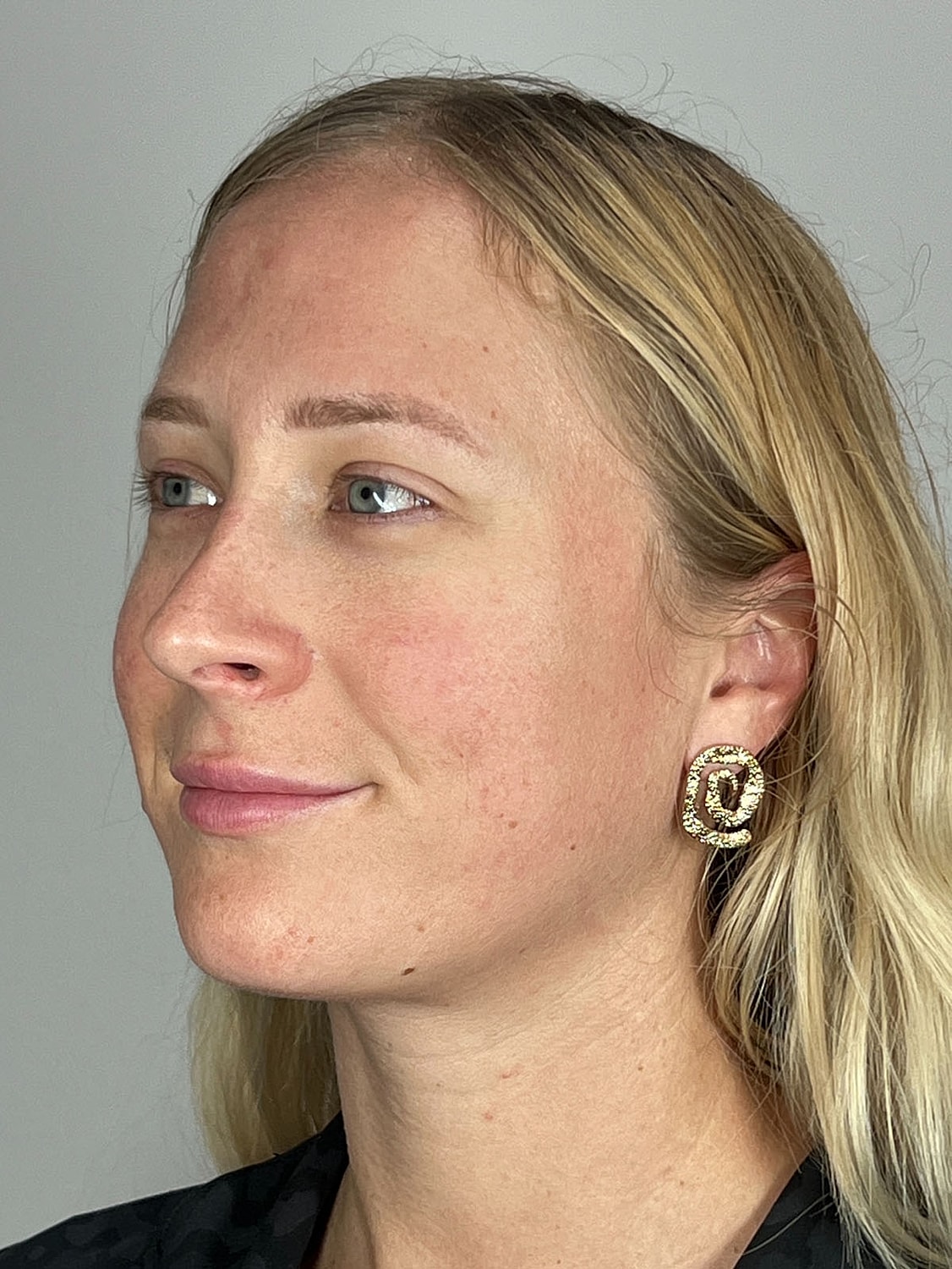 Facial Balancing Before & After
