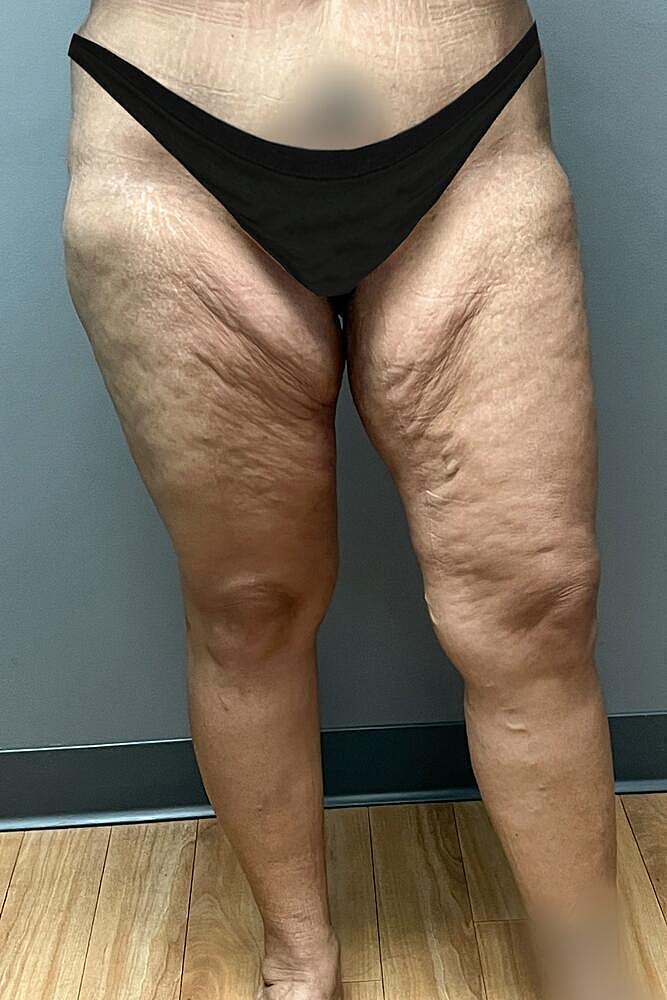 Thigh Lift Before & After