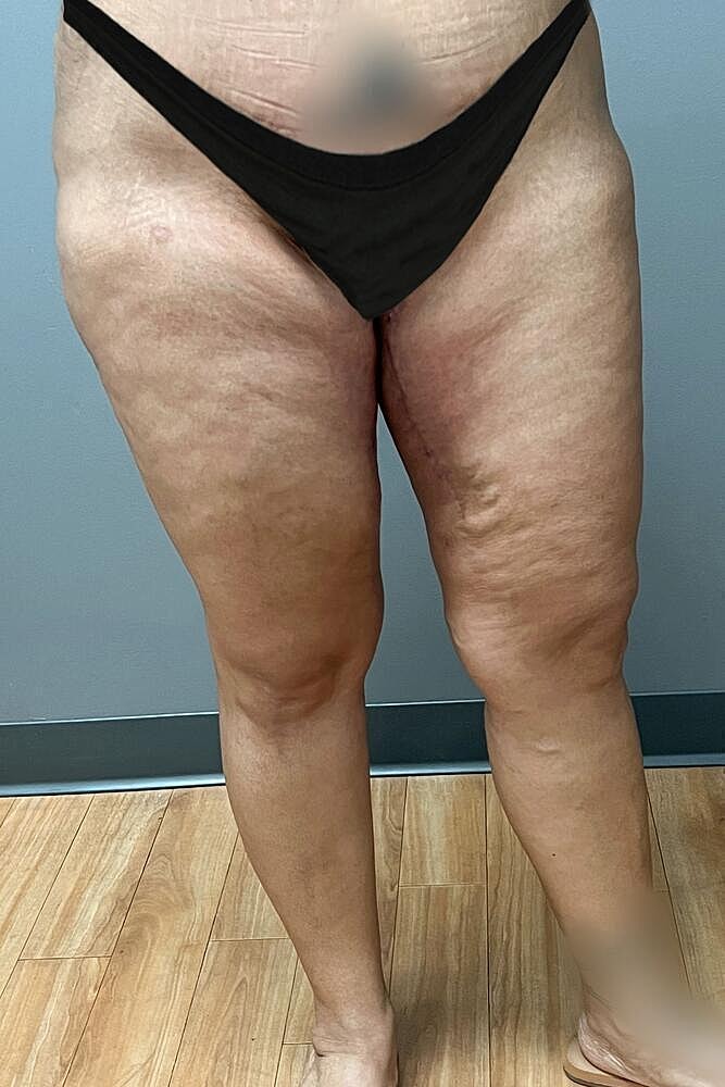 Thigh Lift Before & After