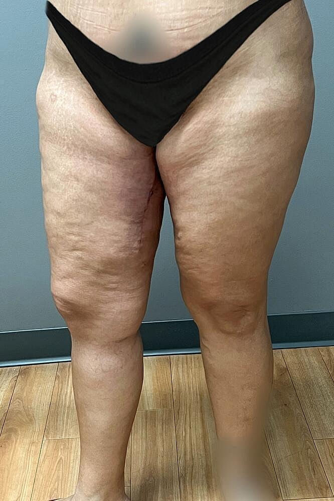 Thigh Lift Before & After