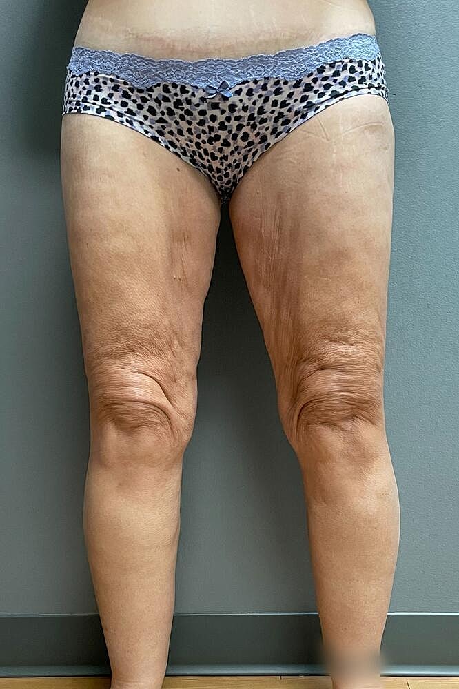 Thigh Lift Before & After