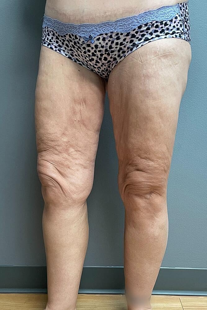 Thigh Lift Before & After