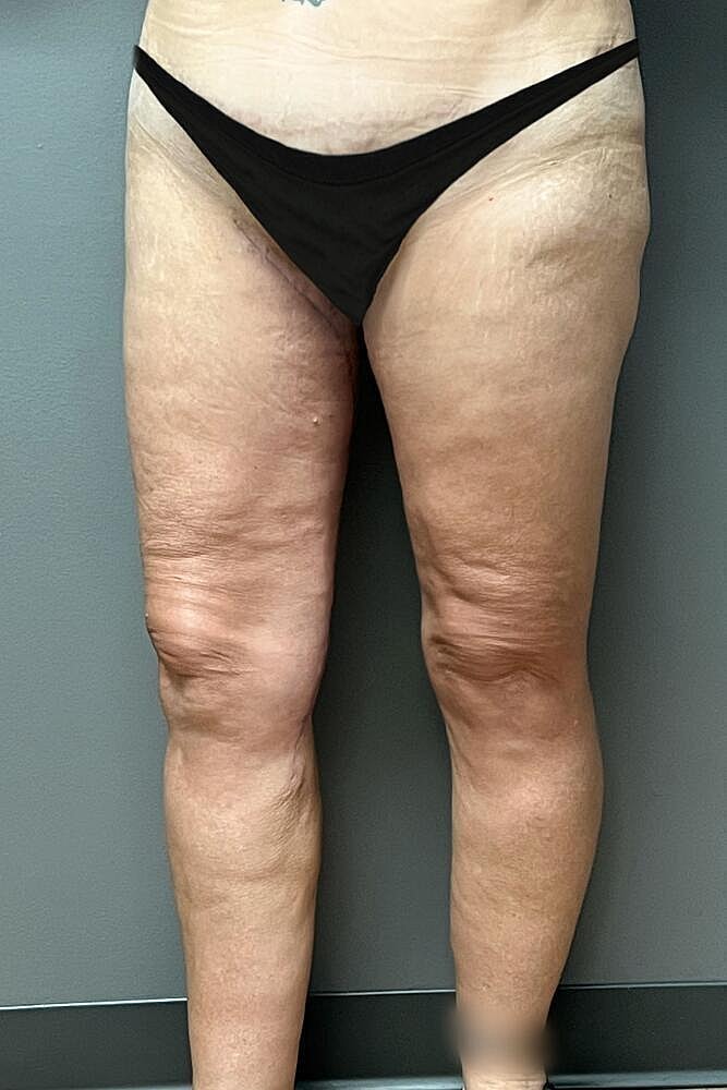 Thigh Lift Before & After
