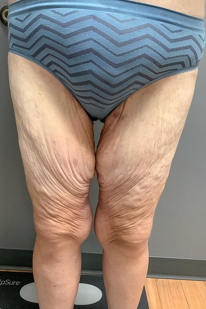 Thigh Lift Before & After