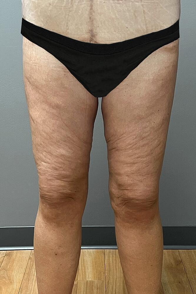 Thigh Lift Before & After