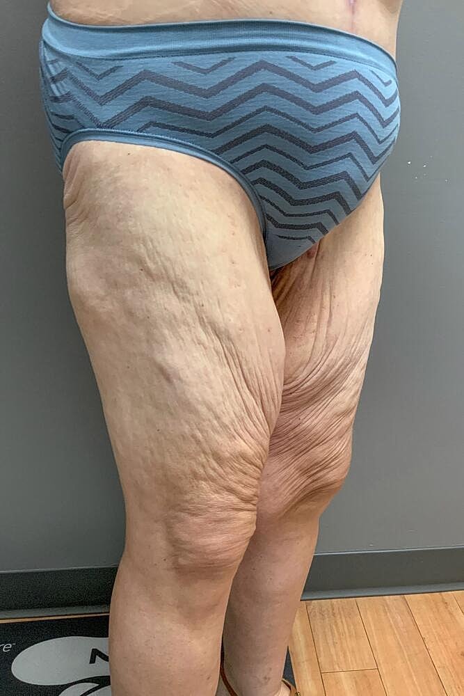 Thigh Lift Before & After