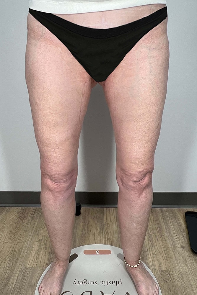 Thigh Lift Before & After