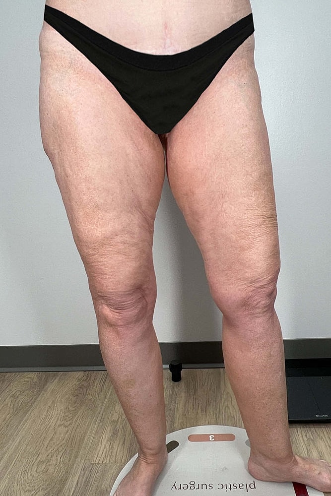 Thigh Lift Before & After
