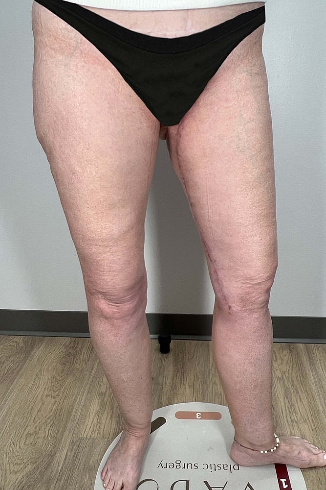 Thigh Lift Before & After