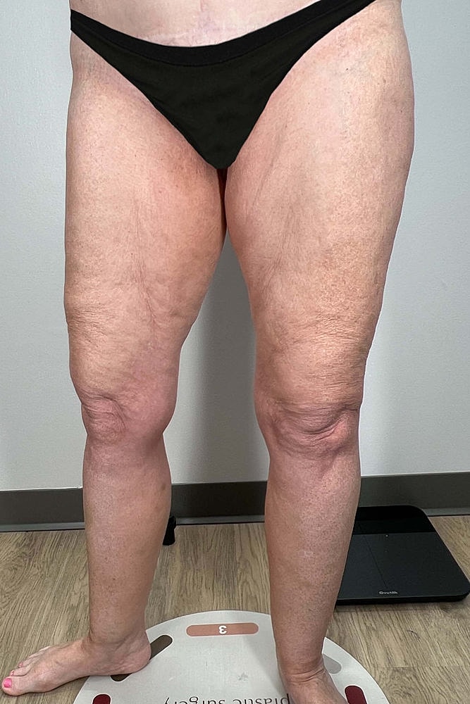 Thigh Lift Before & After