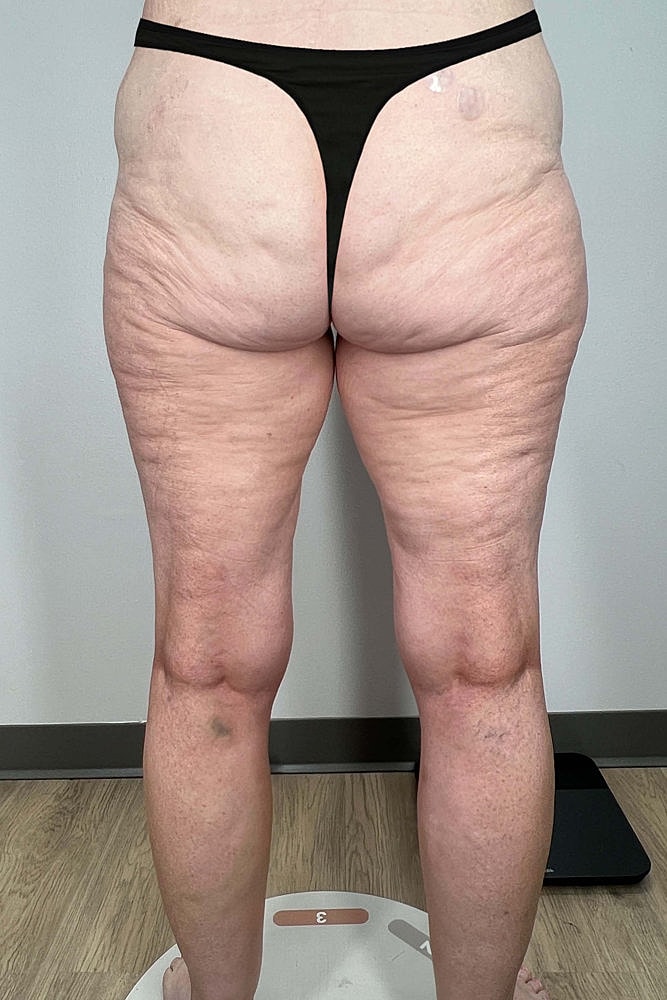 Thigh Lift Before & After