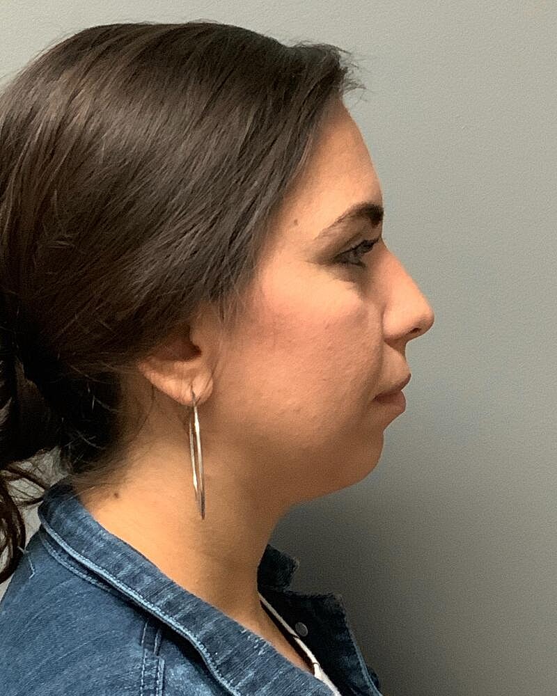Chin Augmentation Before & After