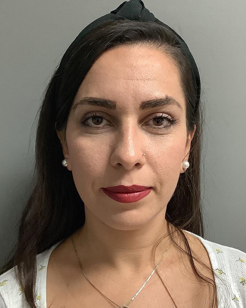 Chin Augmentation Before & After