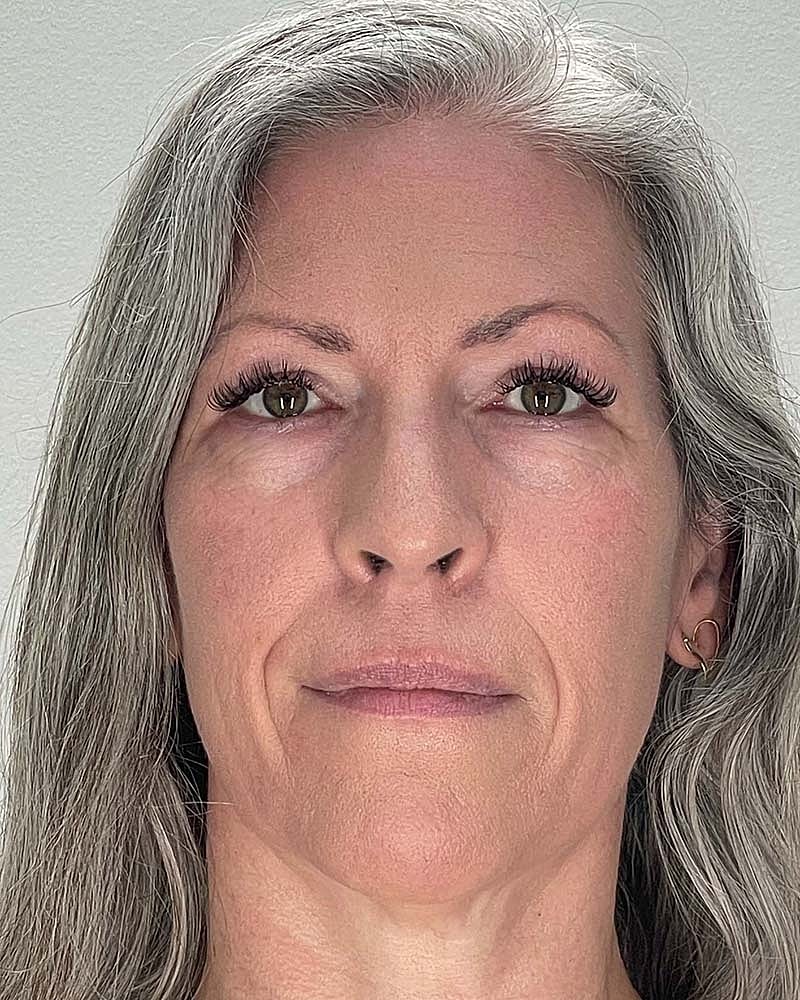 Blepharoplasty Before & After