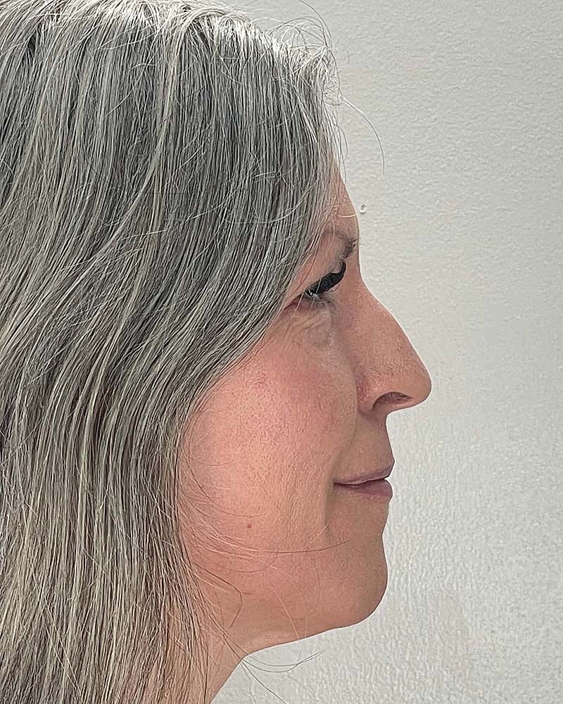 Blepharoplasty Before & After