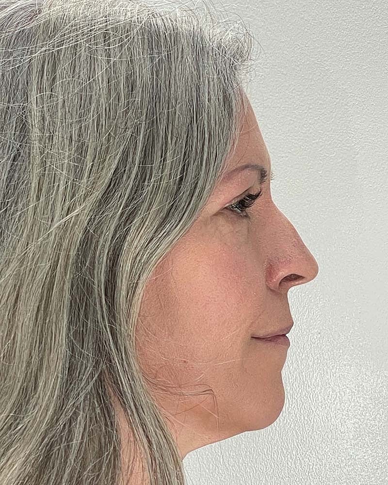Blepharoplasty Before & After