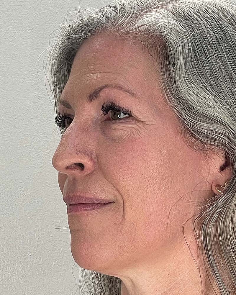 Blepharoplasty Before & After