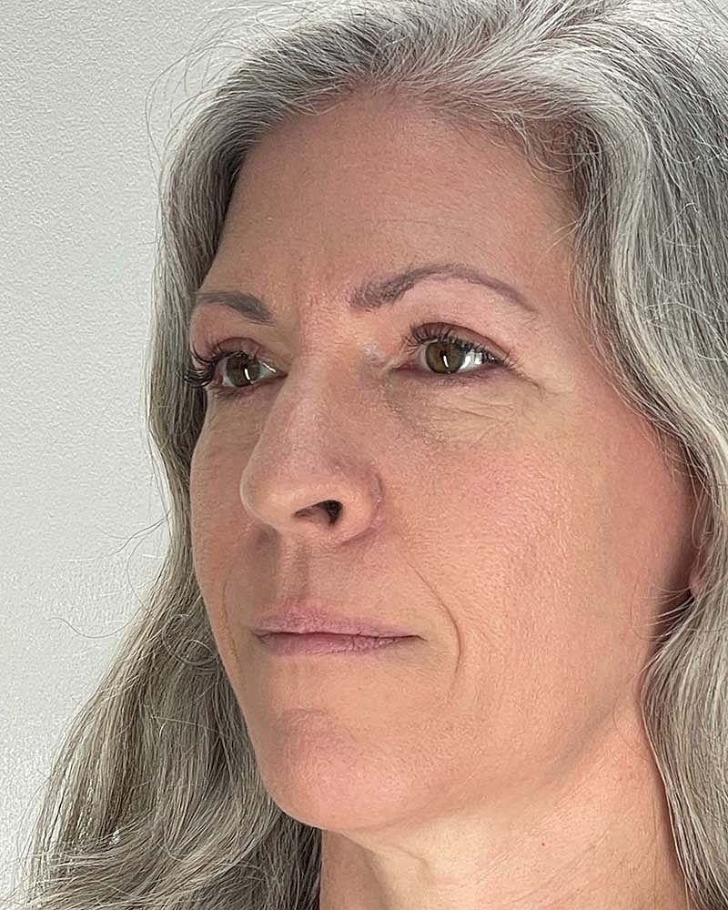 Blepharoplasty Before & After
