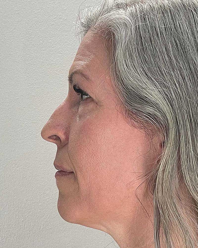 Blepharoplasty Before & After