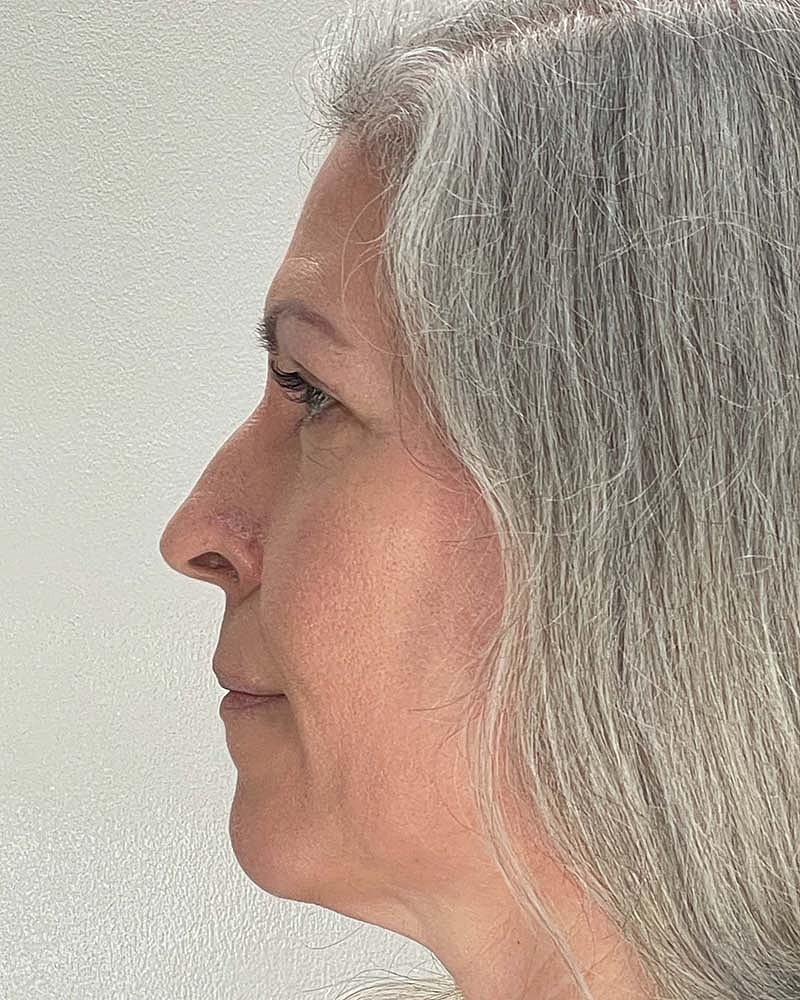 Blepharoplasty Before & After
