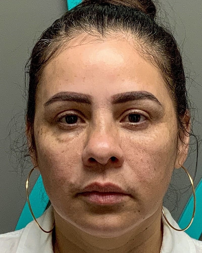 Blepharoplasty Before & After
