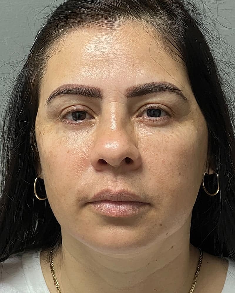 Blepharoplasty Before & After