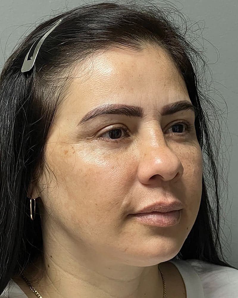 Blepharoplasty Before & After