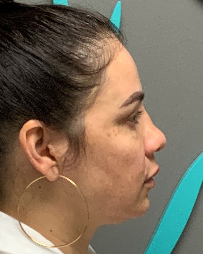 Blepharoplasty Before & After