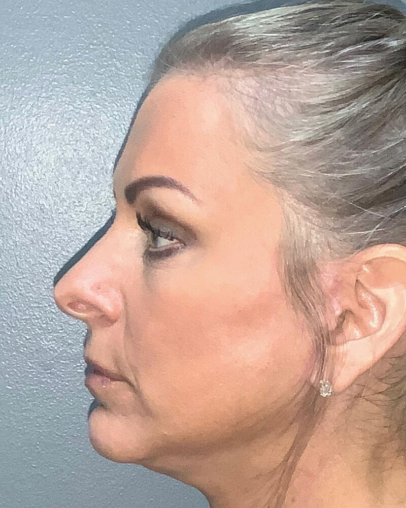 Blepharoplasty Before & After