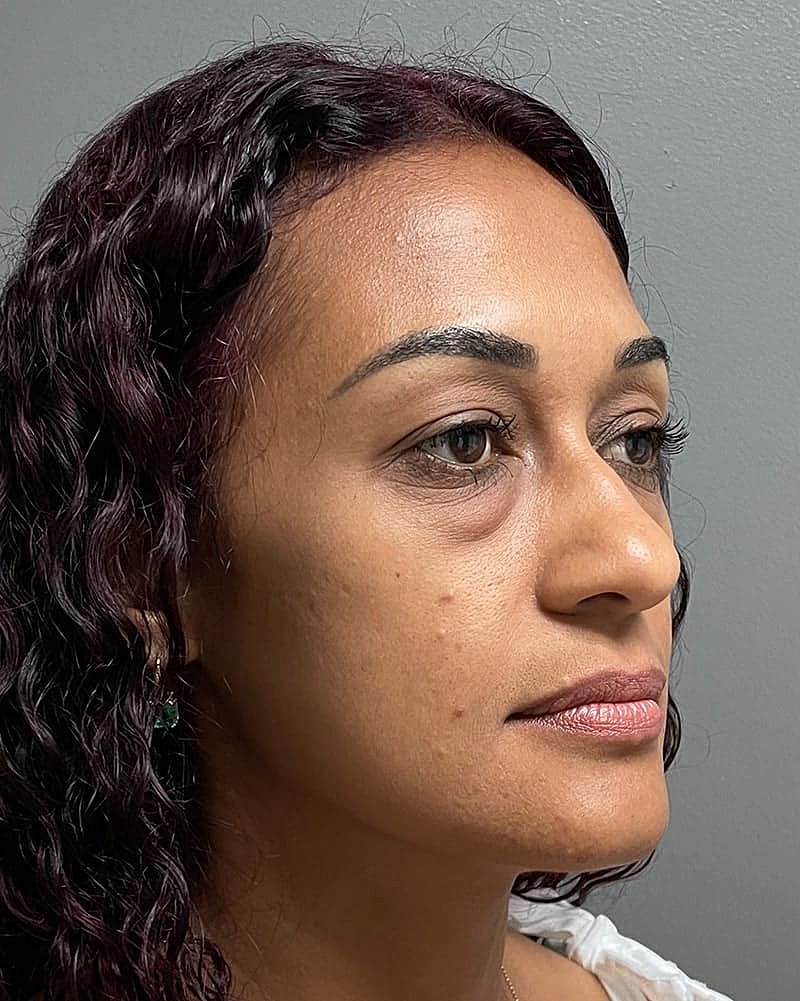 Blepharoplasty Before & After