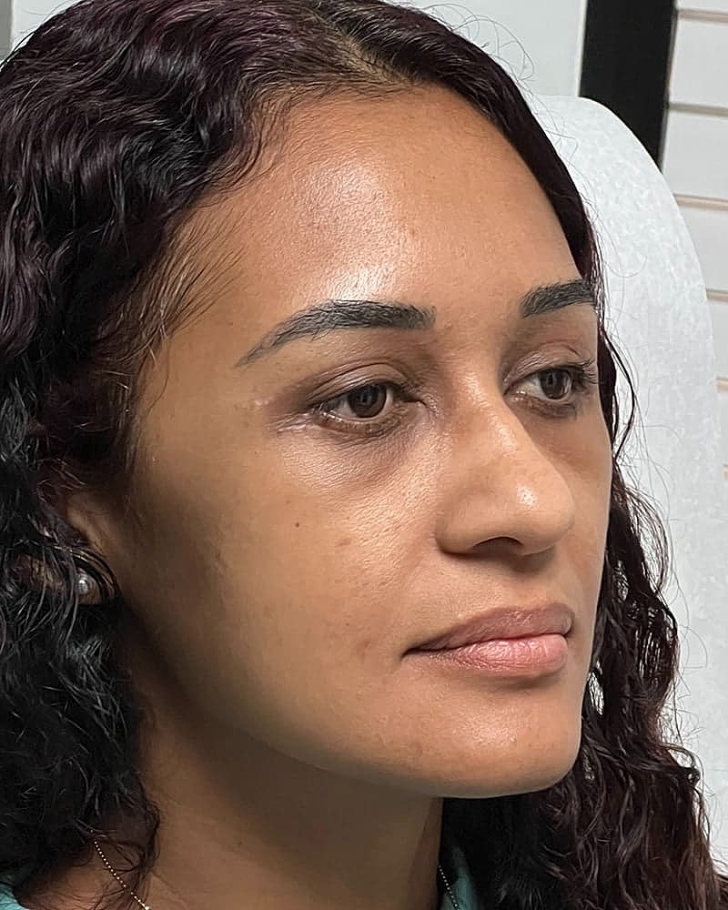 Blepharoplasty Before & After