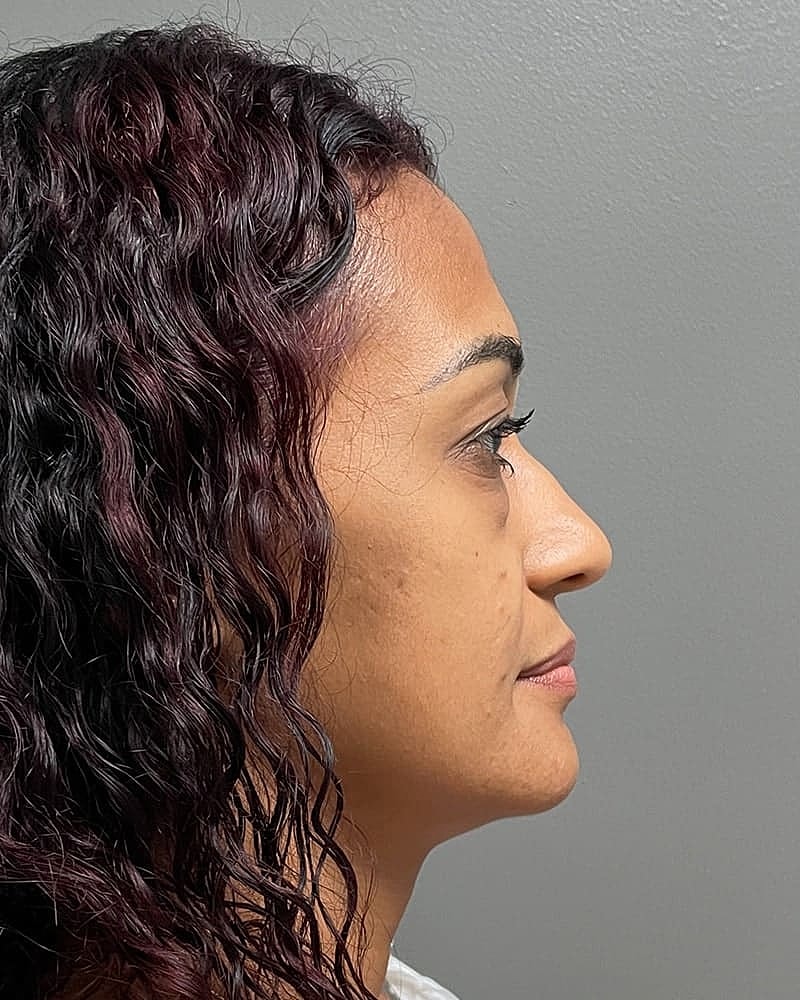 Blepharoplasty Before & After