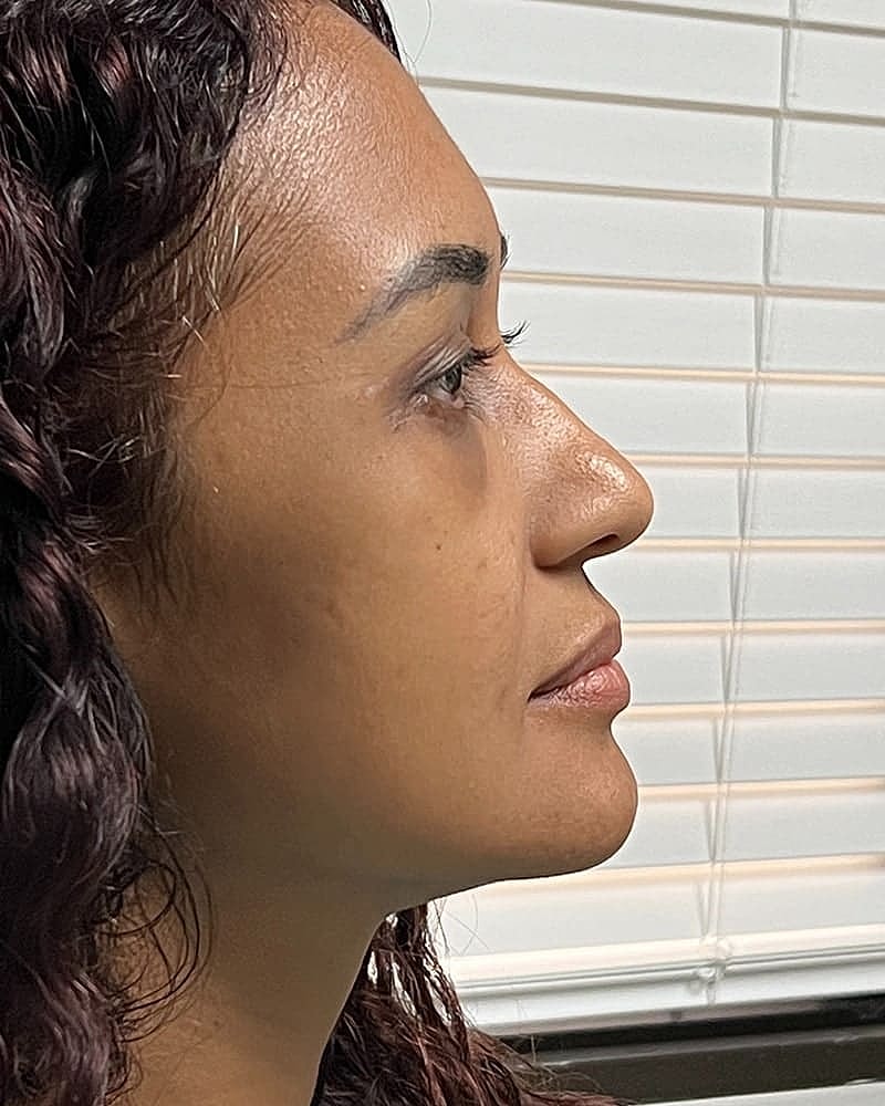 Blepharoplasty Before & After