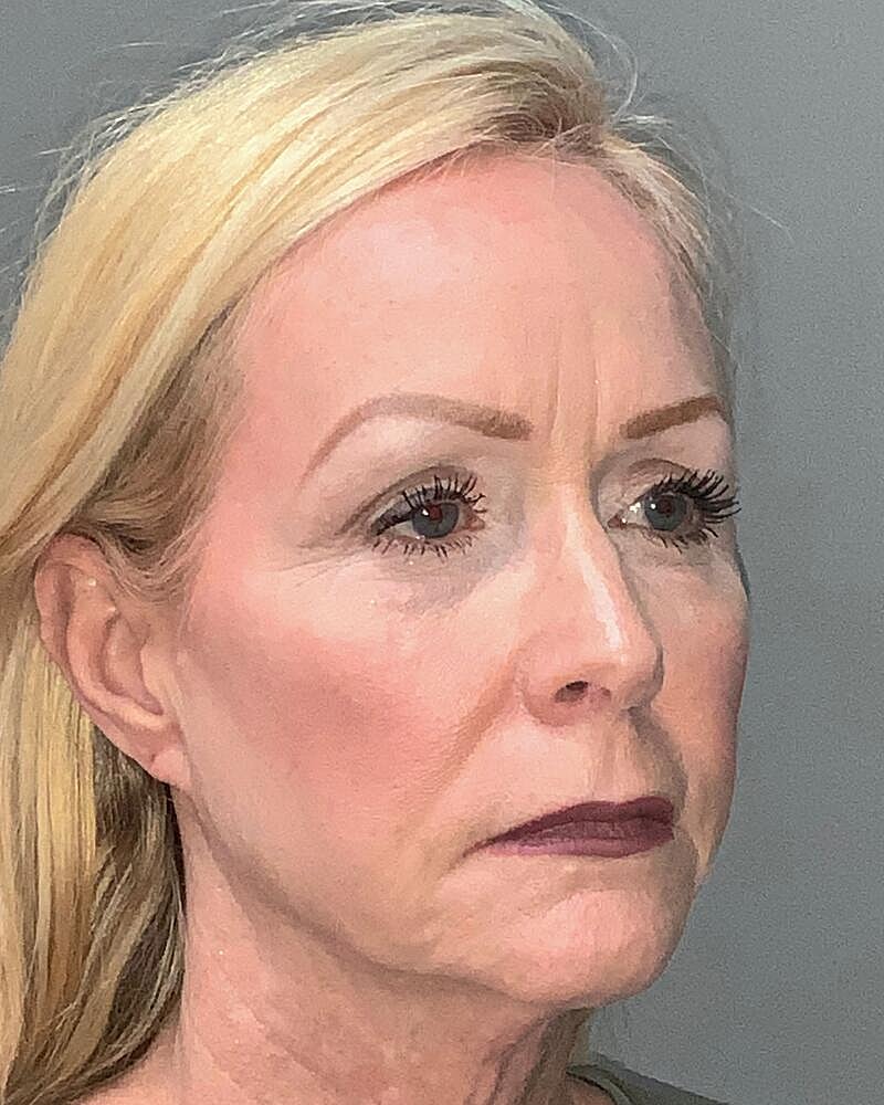 Blepharoplasty Before & After