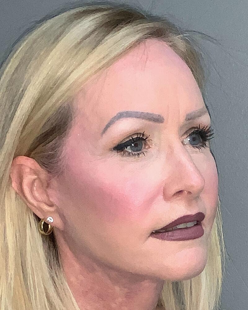 Blepharoplasty Before & After