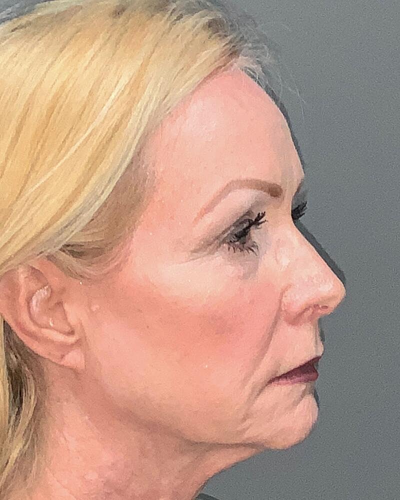 Blepharoplasty Before & After