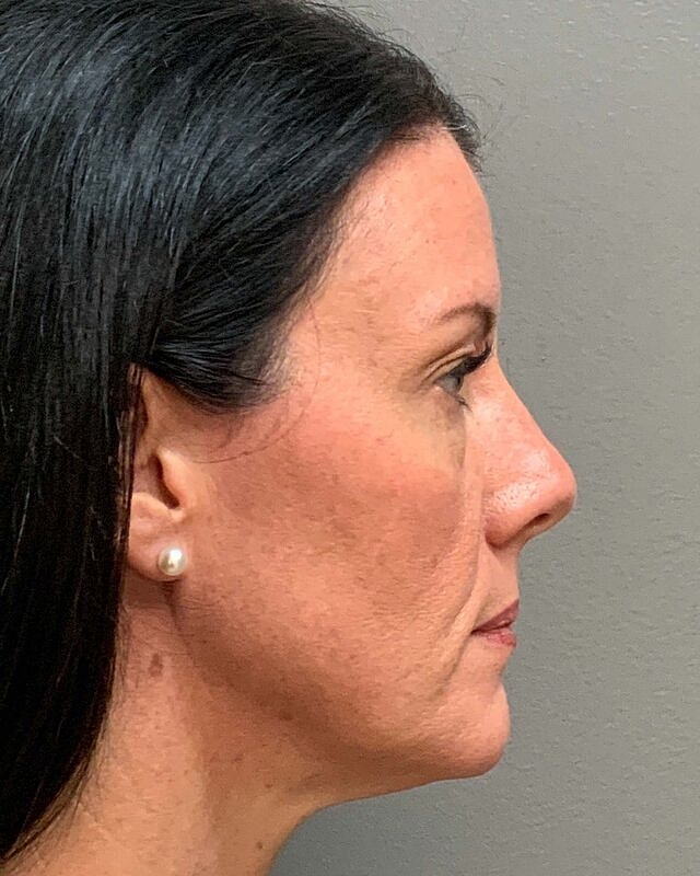 Blepharoplasty Before & After