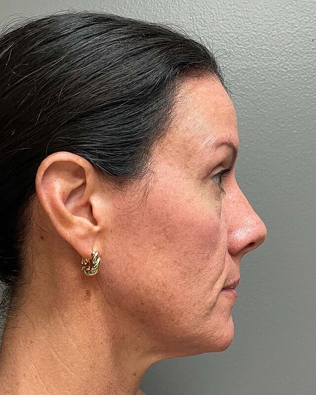 Blepharoplasty Before & After